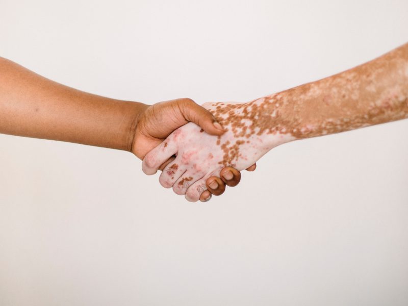 Vitiligo: piores sintomas são preconceito e desinformação