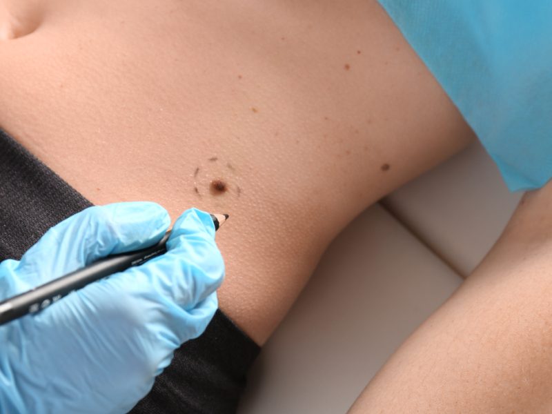 Brasil deve ter mais de 700 mil casos de câncer de pele por ano