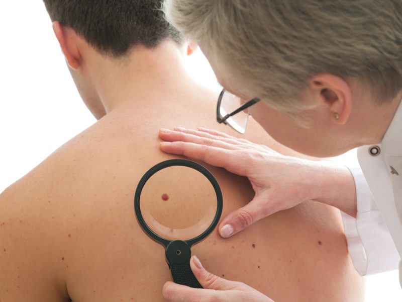 Dezembro Laranja: o que é preciso saber sobre câncer de pele e a novidade da vacina